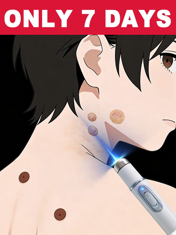 قاتل الثآليل هنا! آمنة وخالية من القلق، تترك بجلدك أملسًا وتوهجًا #1