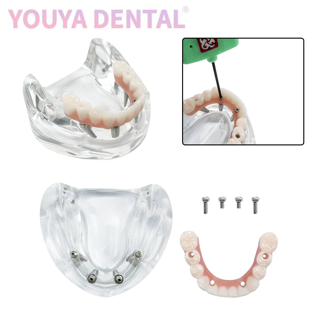 Mandibular Implant Dental Tooth Model With 4 Screws With Removable Denture Repair Bridge Screwdriver Typodont Model Dentist Demo