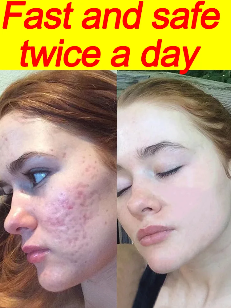 Acne Removal Whitening Cream Effective Fade Acne Spots Repair Gel Oil Control Moisturizing Shrink Pores Acne Treatment Skin Care