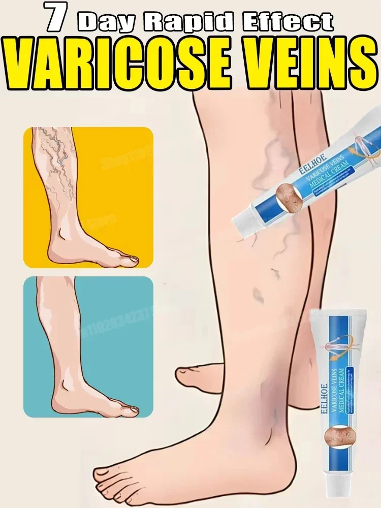 

Varicose vein lightening cream, improves blood circulation and reduces swelling