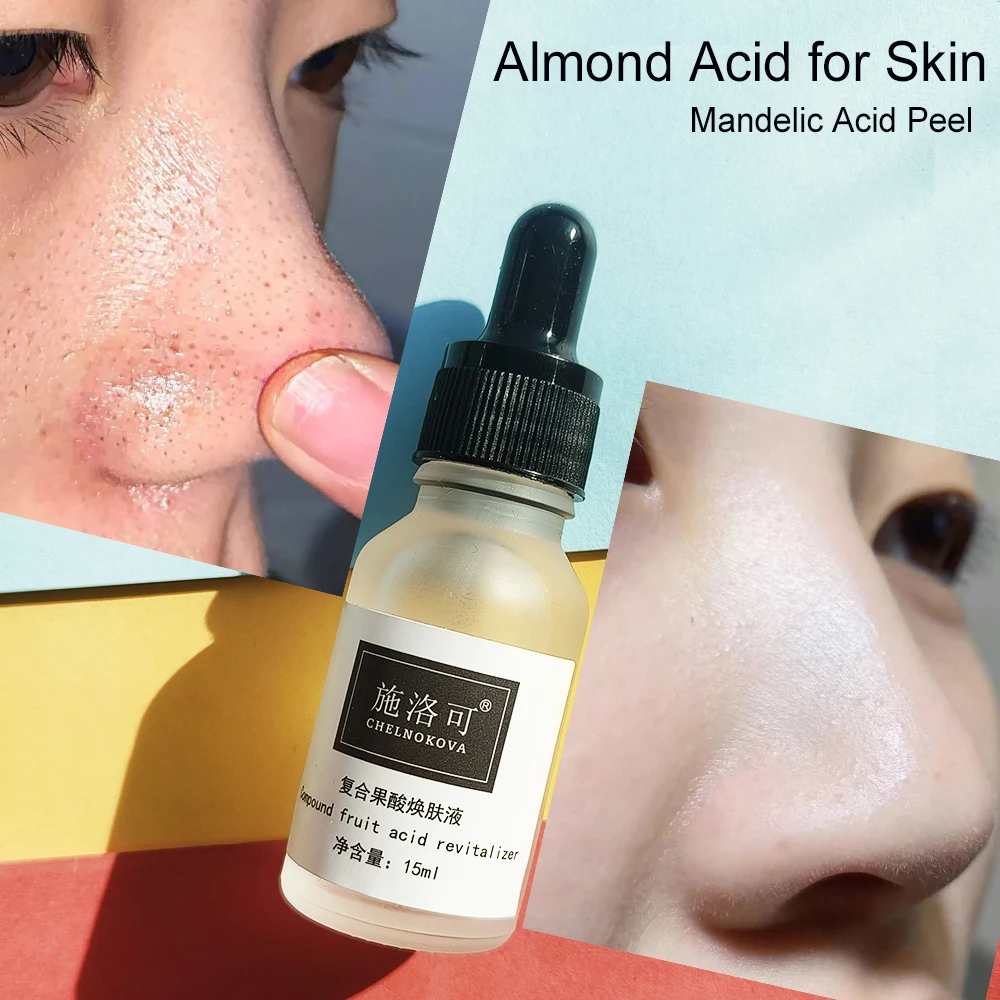 Transform Your Skin with the Miracle of Almond Acid: The Ultimate Solution for Glowing, Healthy Complexion blackhead removal