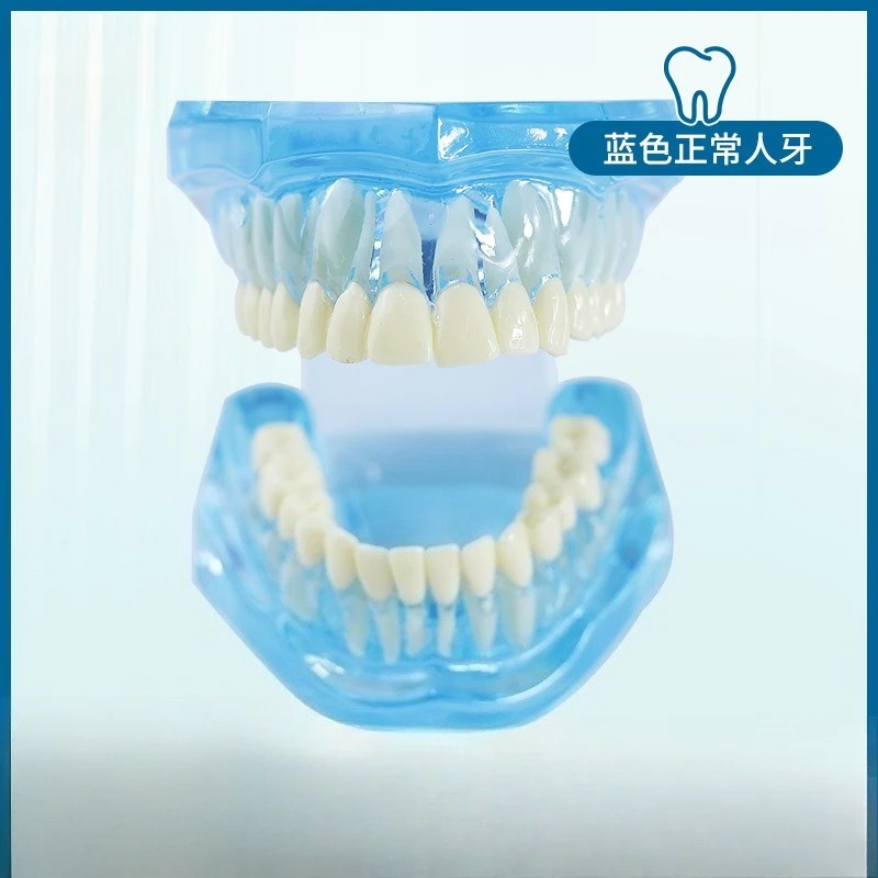 Oral model 6x dental caries compared to 4x classification times dental caries evolution