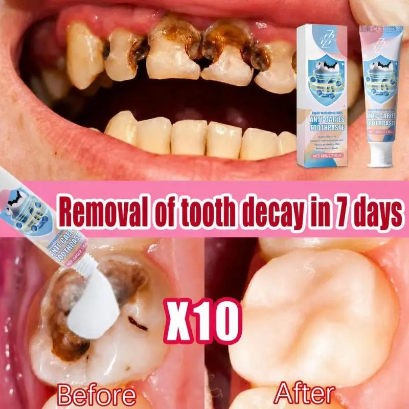 Advanced Cavity Protection – ERASE Early Cavities & Avoid the Drill – Advanced Enamel Repair Toothpaste, Instantly Blocks Decay, Long-Lasting Protection, Sensitive Teeth Safe, Naturally Freshens Breath, Save Thousands on Fillings