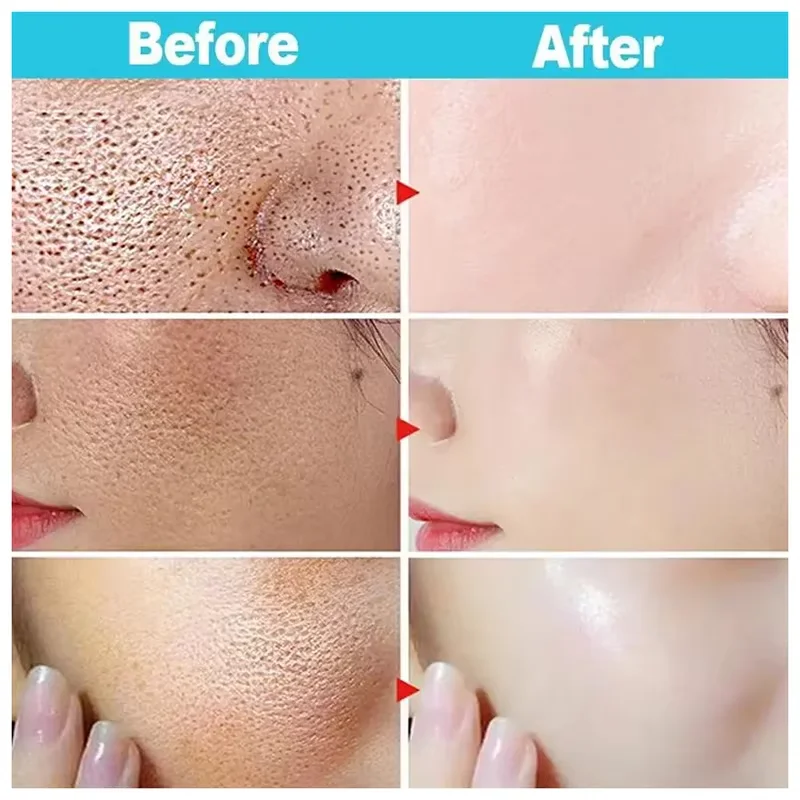 Salicylic Acid Pore Shrinking Cream Eliminate Large Pores Serum Remove Blackhead Acne Repairing Tightening Skin Care Cosmetics