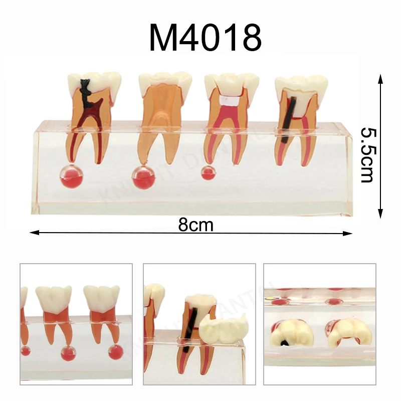 

Teeth Model Dental Endodontic Pathological Treatment Model Dentistry Root Canal Anatomy Study Demonstration Teaching Model