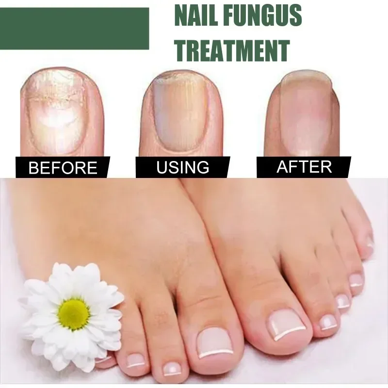 Nail Fungal Treatment Essence Oil Foot Toe Nail Fungus Removal Serum 7 Days Repair Onychomycosi Anti Infection Gel Care Products