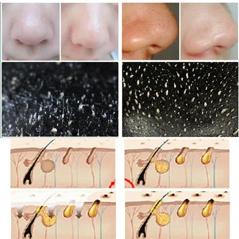 Masker Neus Mee-Eter Verwijderaar Verwijderen Puistje Krimpende Poriën Olie Controle Acne Behandelingsmasker Diepe Reiniging Nasale Zwarte Kop Strips