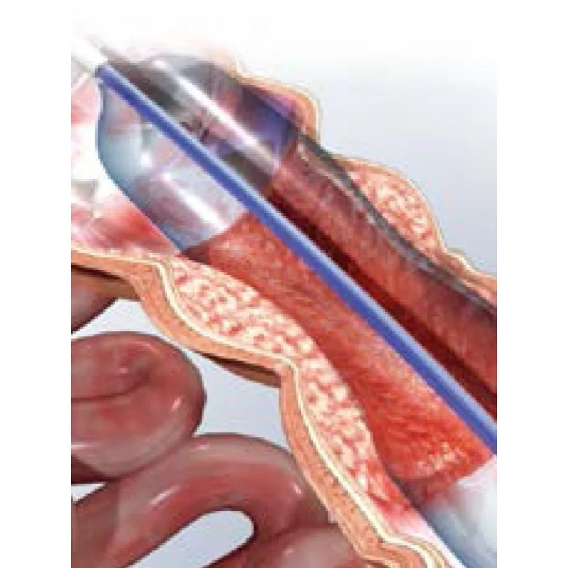 Disposable Balloon Dilation Catheter For The Treatment Of Digestive Tract Gas Stenosis