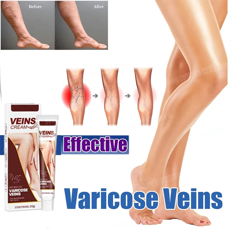 Устраняет васкулит, флебит, успокаивающий уход за кожей ног-паука