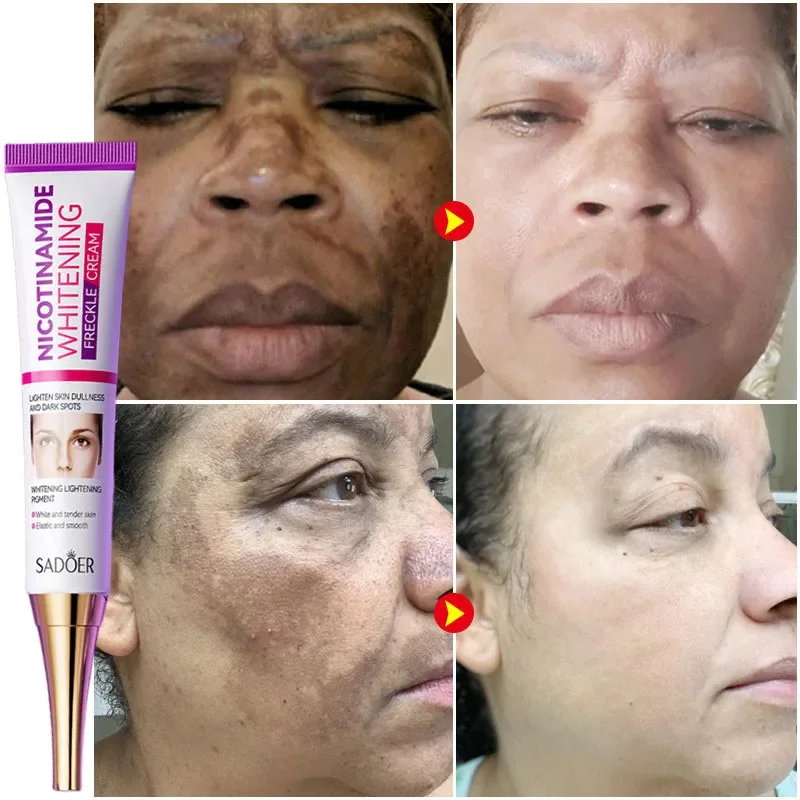 Face Brightening Cream Niacinamide Reduce Chloasma Melasma Melanin Fade Fine Lines Lighten Dark Skin Serum Care Brighten Cream