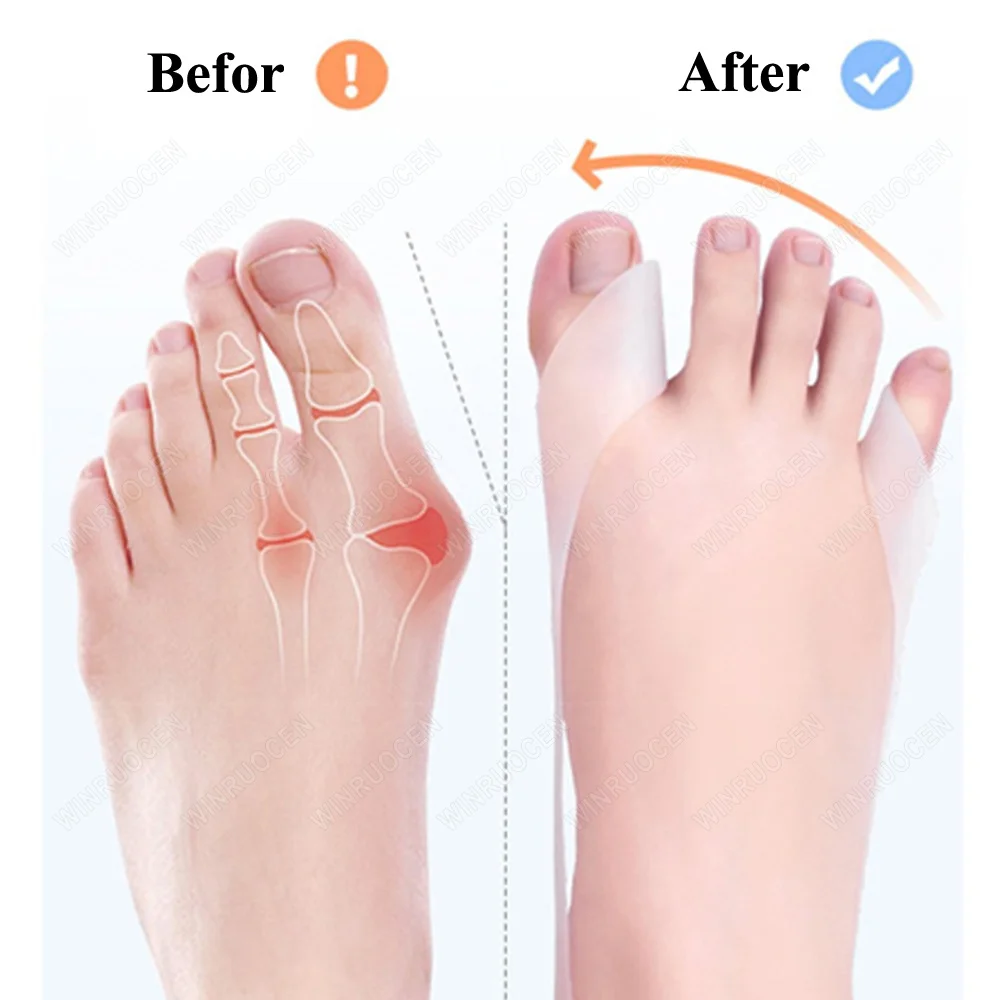 1 Paar Siliconen Teen Orthese Bunion Voetverzorging Tool Plastic Hallux Valgus Corrector Separator Vingerpijnverlichting Pedicure Riem