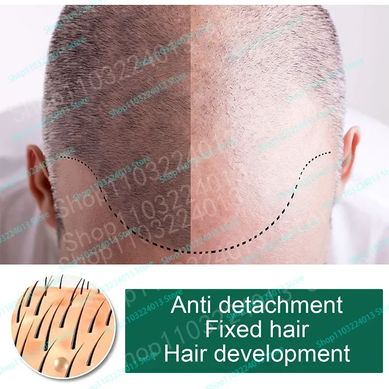 Sdotter New Fast Hair Growth Essence Oil Products Effective Baldness Repair Treatment Anti Hereditary Seborrheic Alopecia Loss F