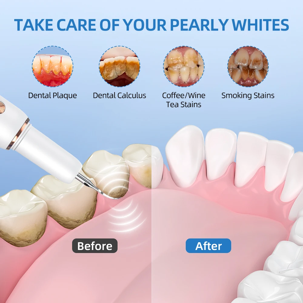 Thumbnail 4 - #38 Highest Rated Ultrasonic Dental Scalers to Buy in 2026