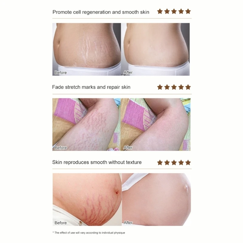 Rose Stretch Marks Removal Mark Cream Postpartum Obesity For Pregnant Woman