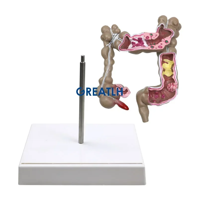 GREATLH Colorectal Lesion Model Colon Pathological Colorectal Cancer Model Medical Teaching Learning Tool