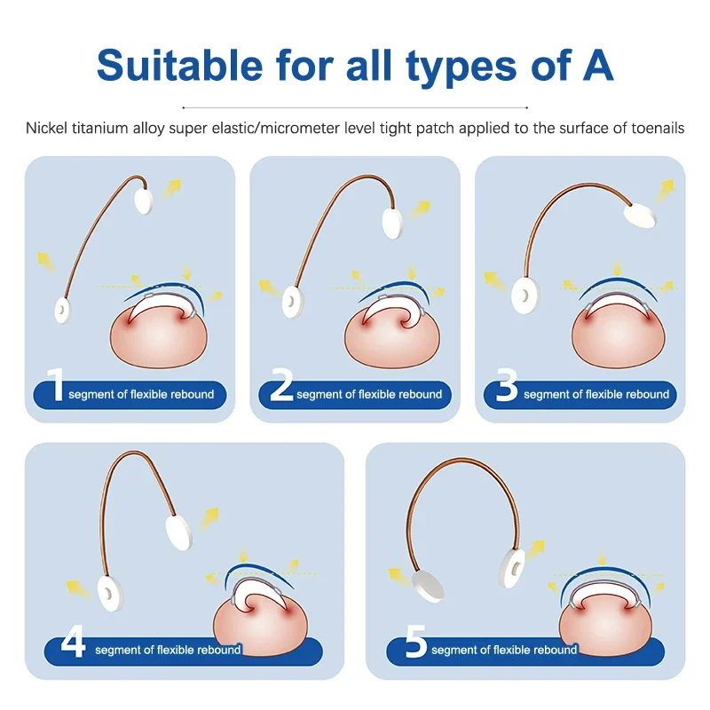 陥入爪矯正ツール 陥入爪治療用弾性パッチステッカー 矯正クリップブレース ペディキュアツール