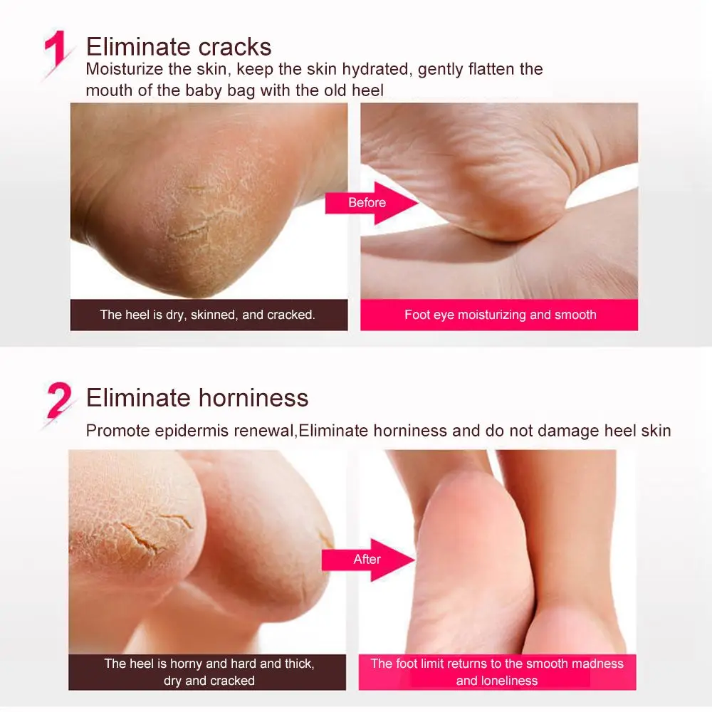 منتج جديد العناية بالبشرة القدم المفتوحة تو الكراك الجاف شفاء هلام السيليكا متصدع إصلاح القدم حماية كعب الحرس كعب حامي