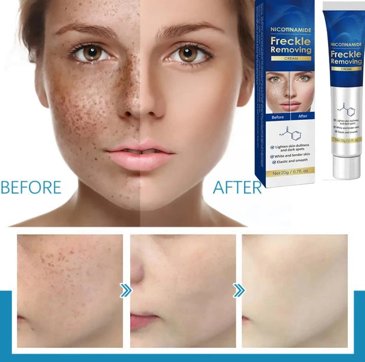 Powerful Whitening Cream Skin Care Remove Freckle Melasma Dark Spots Corrector Lighten Melanin Pigmentation Brighten Product