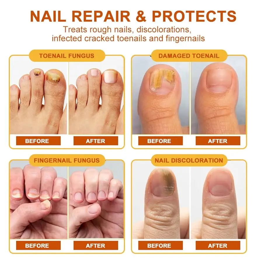 Nagel Schimmel Behandeling Essentie Verwijderen Onychomycose Reparatie Beschadigde Nagels Anti Teen Infectie Gel Voeten Crème Verwijdering Nagels Schimmel