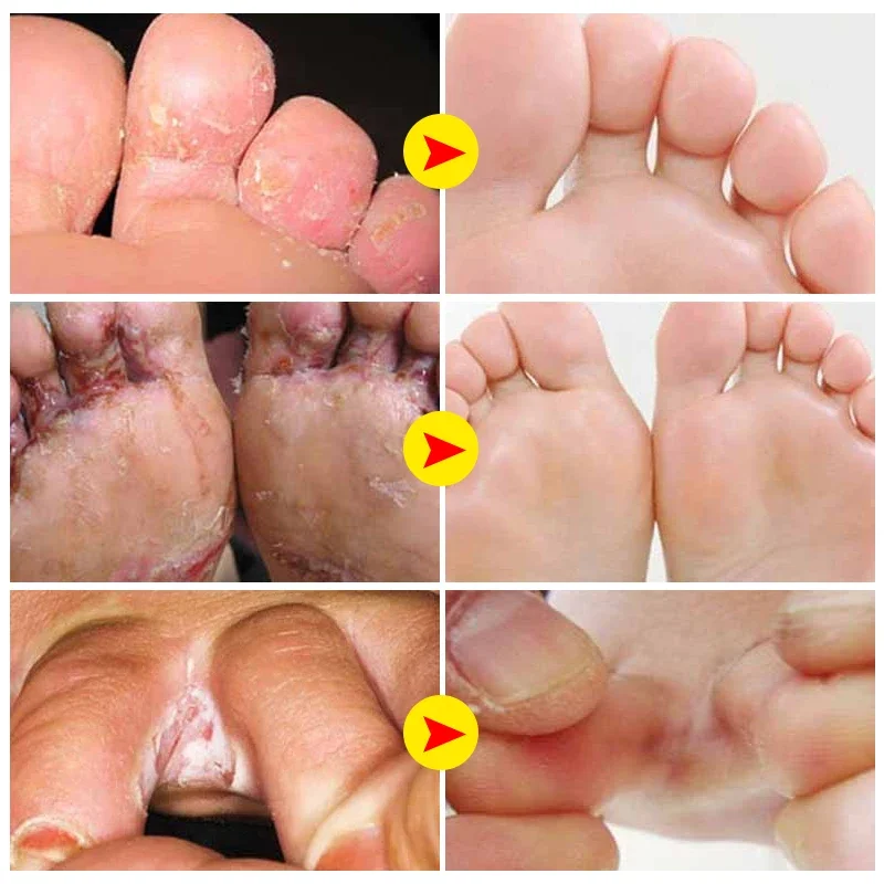 Crème de traitement pour les pieds Tinea Pedis, pommade béribéri soucieux, anti-démangeaisons, inhibe les champignons, peeling des pieds d'athlète, crème médicale, A942, 5 pièces