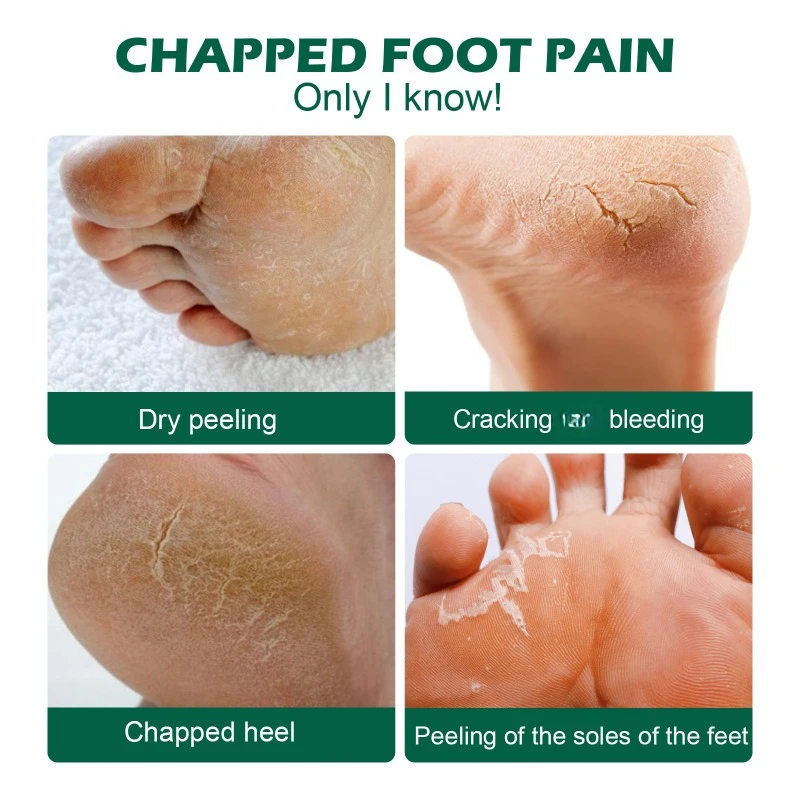 Anti Cracked Heel Treatment Cream relieve Dry itchy peeling Removal Callus Dead Skin Balm Foot Mositurizing Repair Skin Care