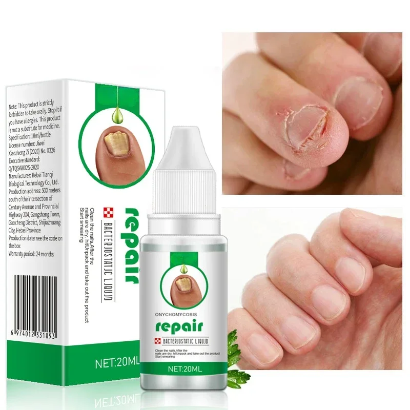 Nail Fungus Treatment Serum Toe Fungal Repair Products Hand Foot Care Removal Gel Anti Infection Onychomycosis Paronychia