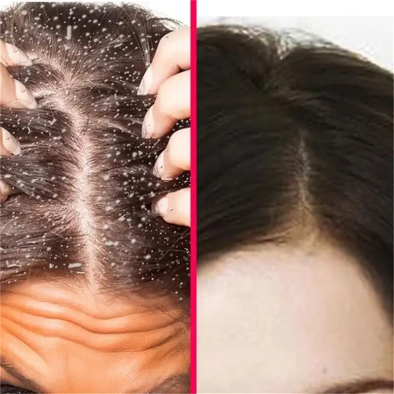 Fast Dandruff Treatment Serum Spray Anti Itching Flaking Oil Control Cleaning Products Scalp Repair Conditioner Hair Care