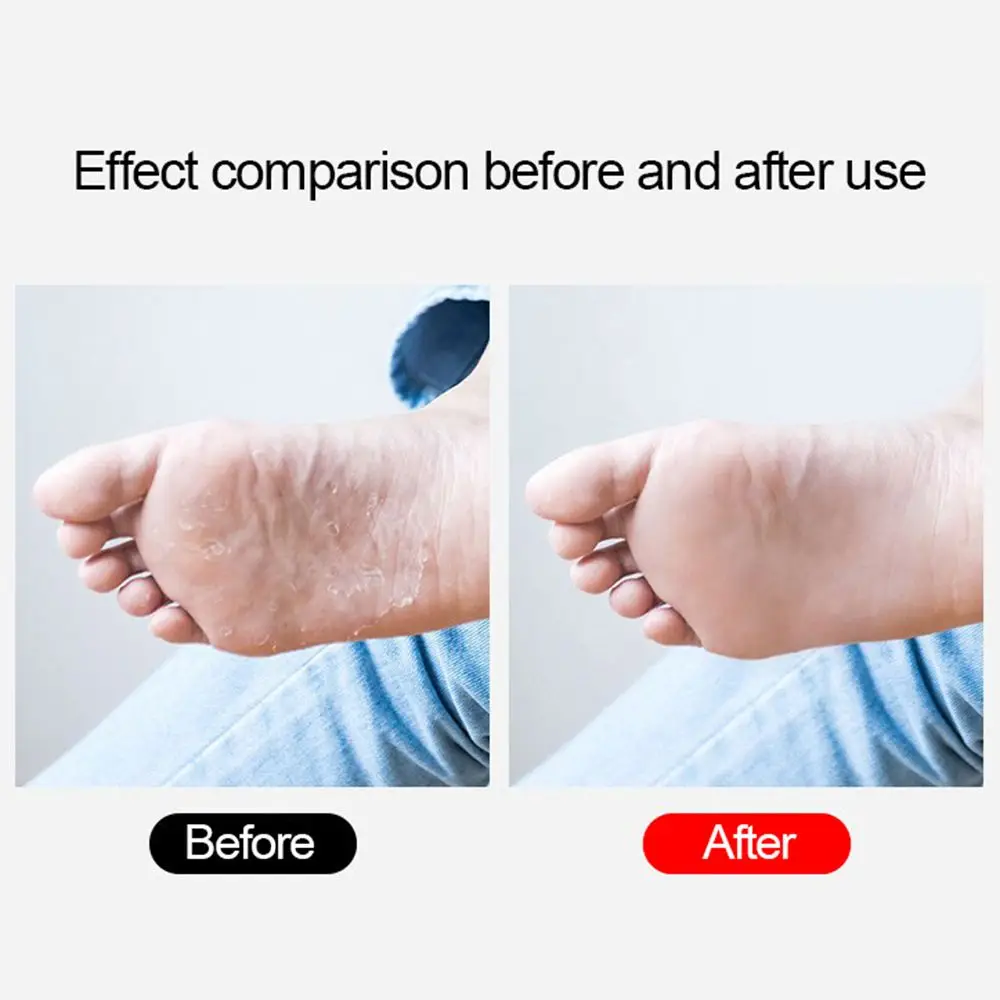 Remover pele dura ralador de pé pé rasp arquivo de pé removedor de calos colossal purificador de pé aço inoxidável