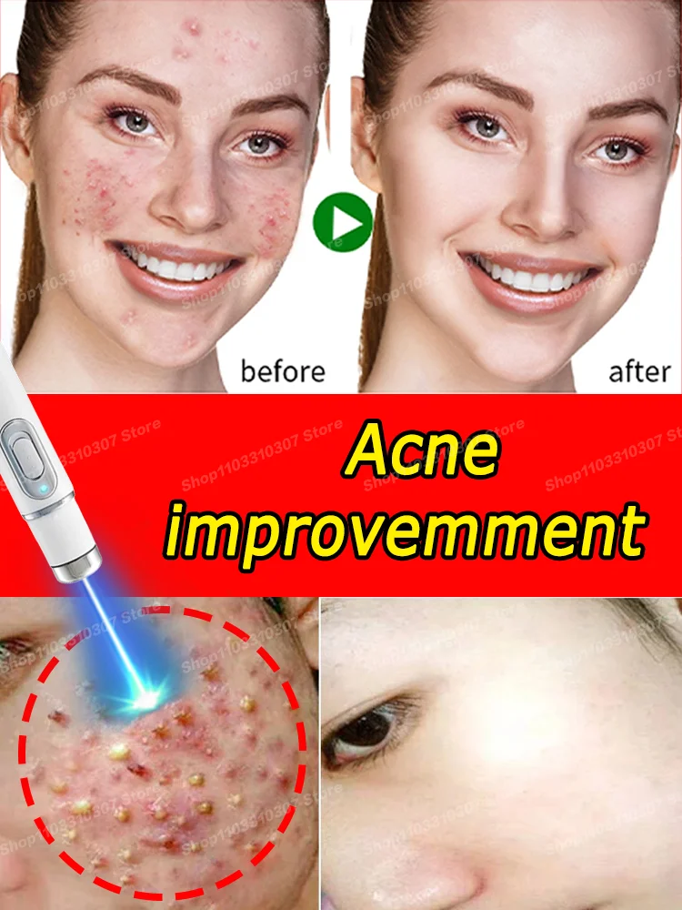 Acne Treatment Cream Repair Pimple Spots Deep Cleaning Pore Shrinking Control Moisturizer Skin Care