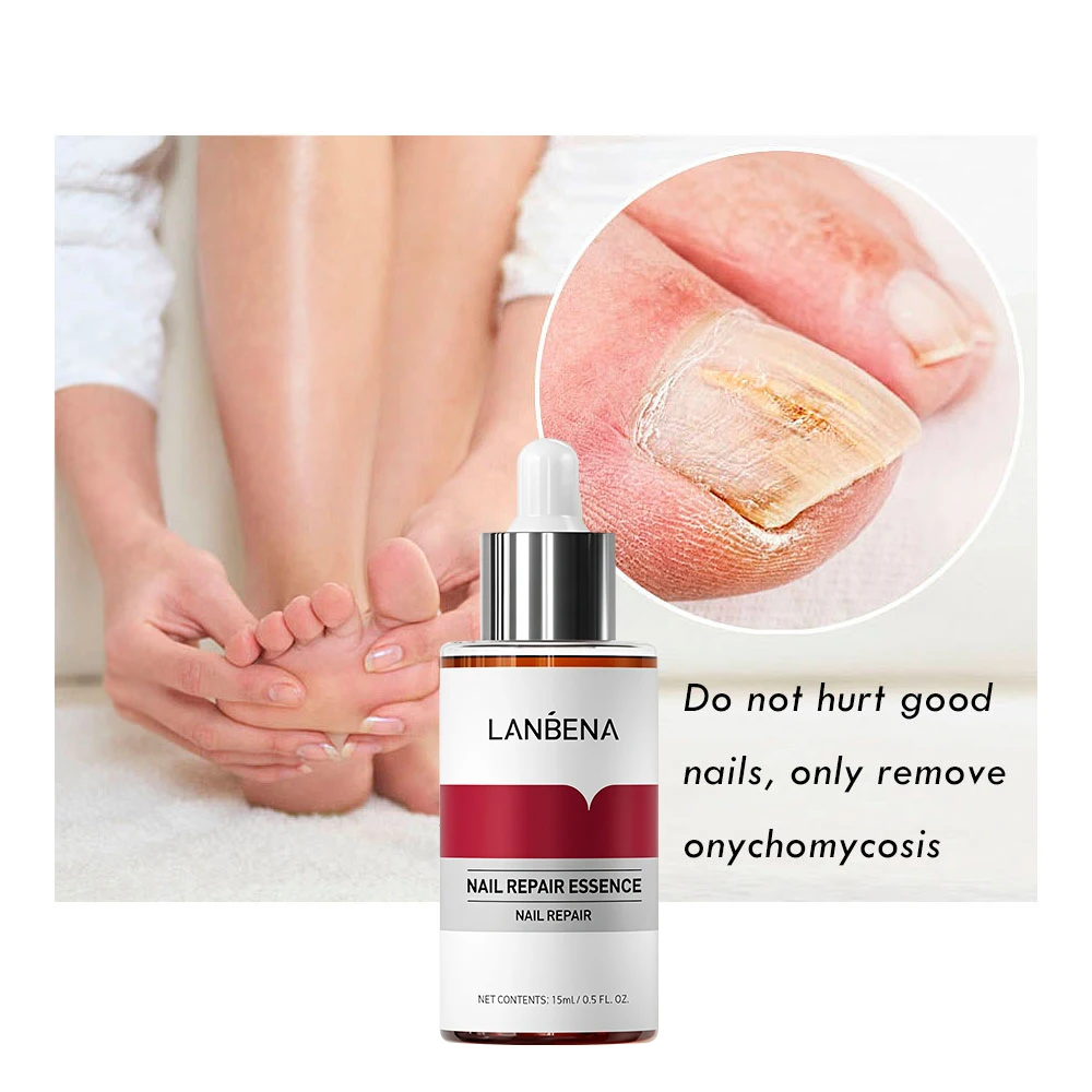 1/2/3/5PCS Fungal NAIL Repair Essence Serum Liquid มือเท้านิ้วมือเล็บผลิตภัณฑ์ดูแล Anti Paronychia Onychomycosis Toe Care