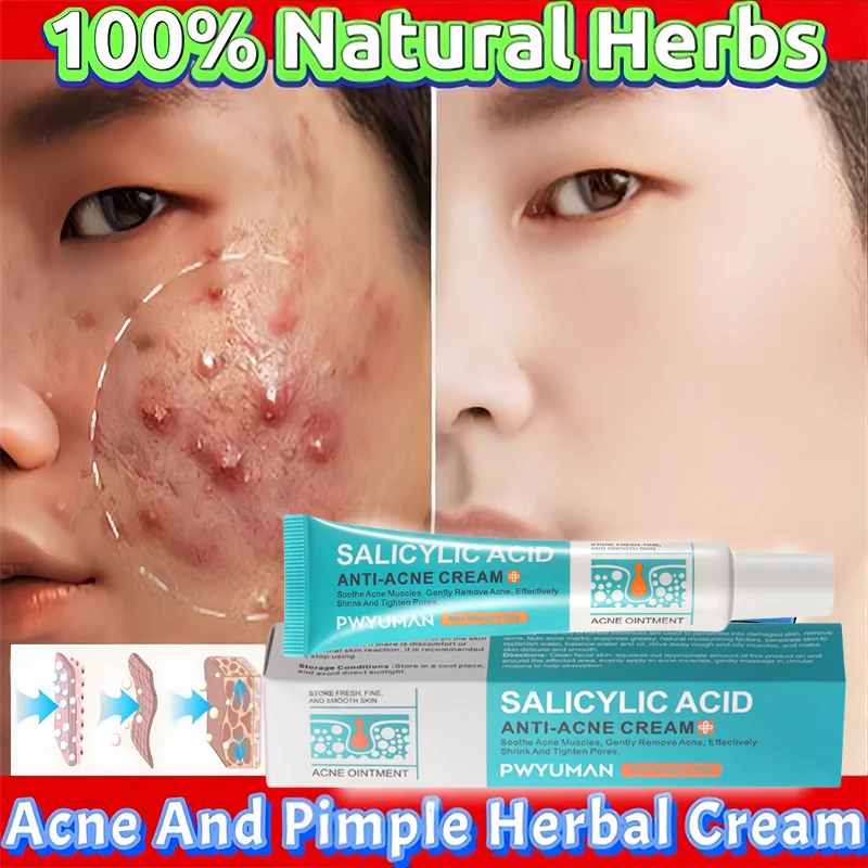 

Herbal Acne Removal Face Cream Clears Pimple Scar Black Dots Gel Acne Treatment Shrink Pore Skin Whitening Lightening Ointment
