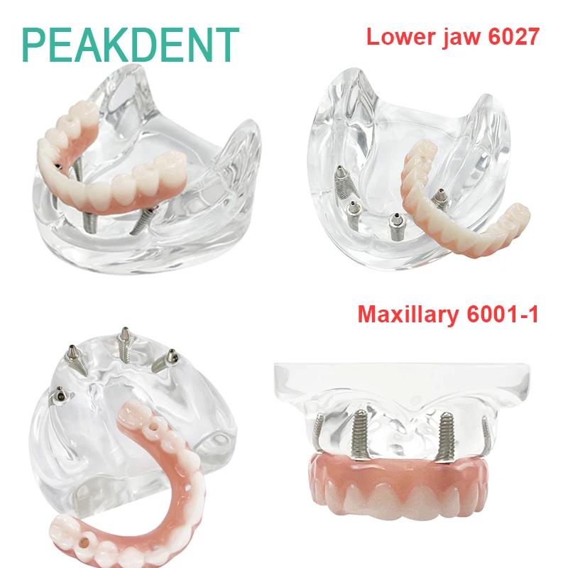 

Dental Teaching Research and Training Model with 4 Detachable Screw Upper and Lower Mandibular Covered Denture Implant Model