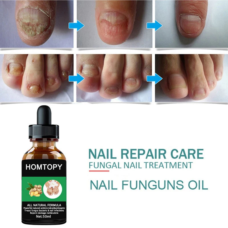 Efficient Nail Repair Solution Treating Cracked Discolored Nails Gray Foot Care Toe Nail Sterilization Gel Nourishing Essence