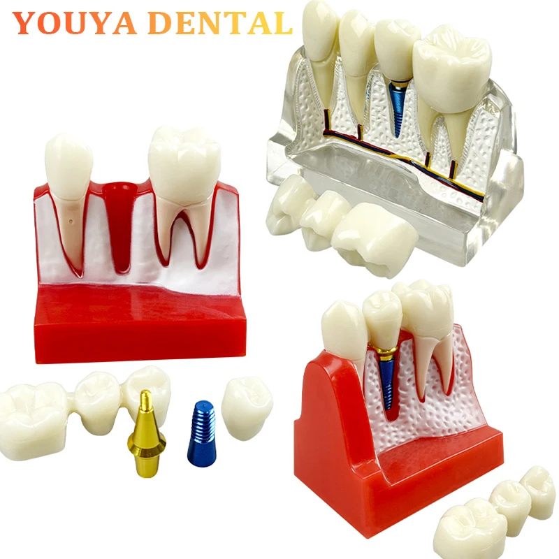 Dental Removable Crown Resin Dental Body Model 4 times Dental Implant Model Research Teaching Demonstration Model
