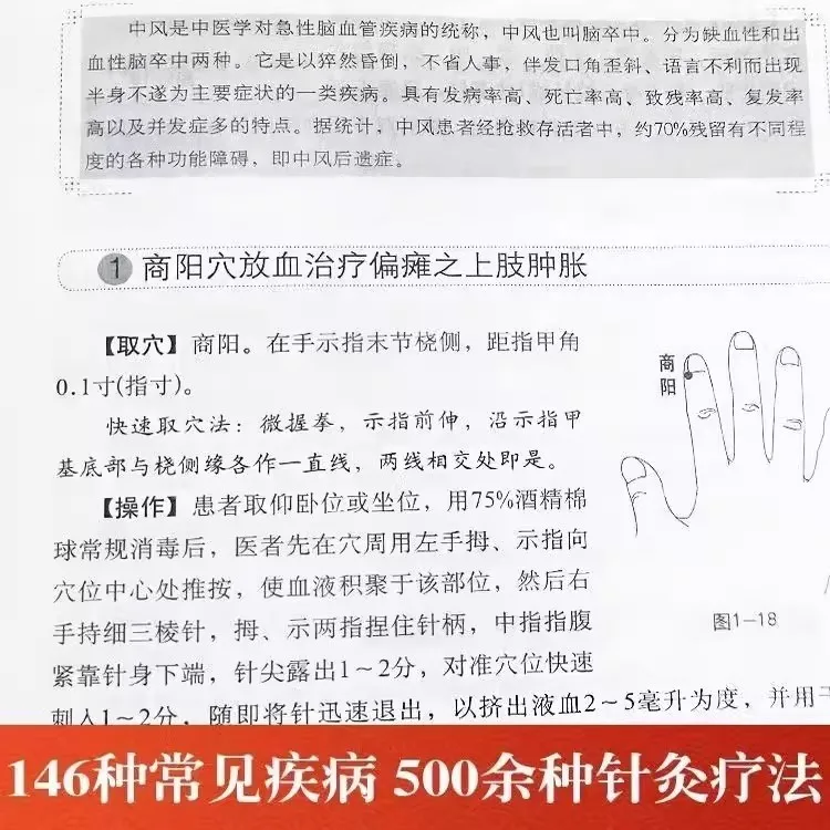 Libro di agopuntura per tutti i tipi di malattie Più di 500 tipi di metodi di agopuntura e moxibustione per 146 malattie comuni