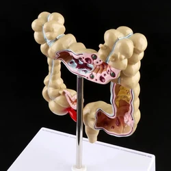 Colorectal Lesion Model Human Colon Snake Large Intestine Pathological Diseases Model Medical Organizer Anatomy Drop Shipping