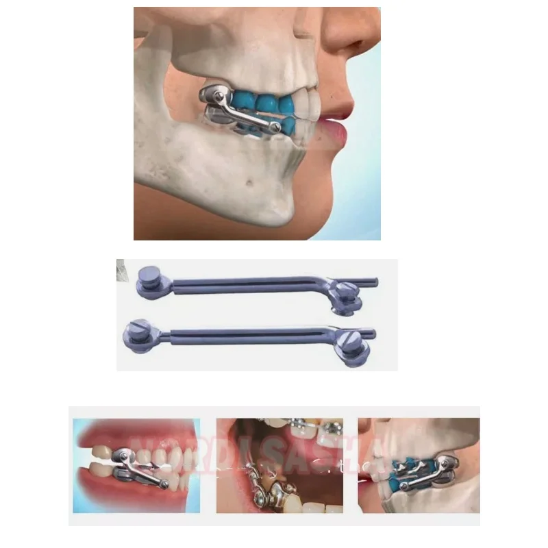 1 conjunto de aparelho dental herbst conjunto denturum parafuso soquete telescópico ortodôntico classe ii correção