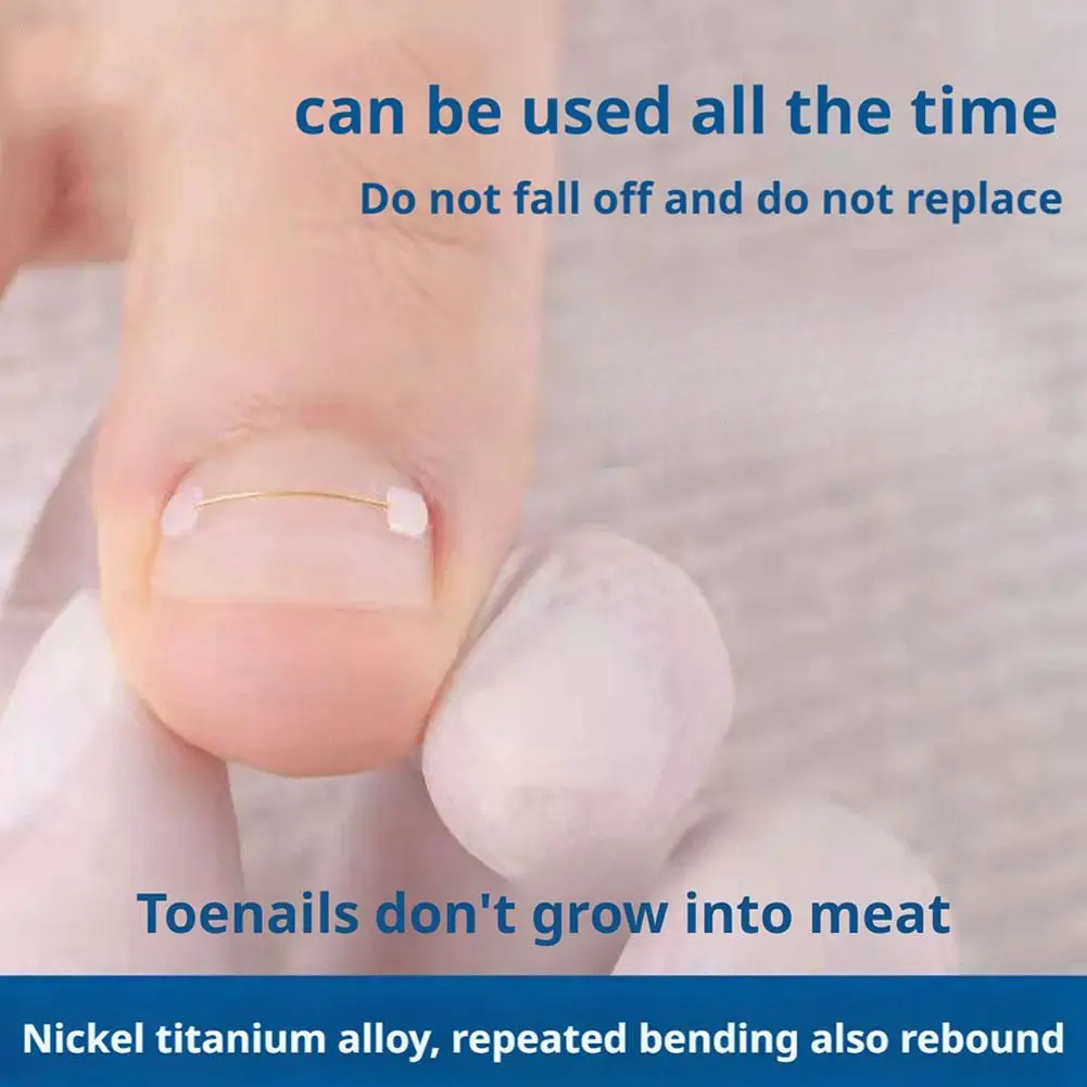 

Titanium Alloy Toenail Corrector Orthopedic Sticker Memory Wire For Ingrown Nail Treatment Hallux Valgus Care Kit Ingrown N Z7R3