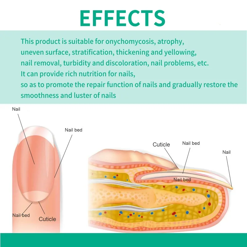 เชื้อราเล็บ Solution หนาเล็บเปราะบางบรรเทาอาการปวดเล็บ Brightening ลบ Onychomycosis เชื้อราเล็บสุขภาพ Cure