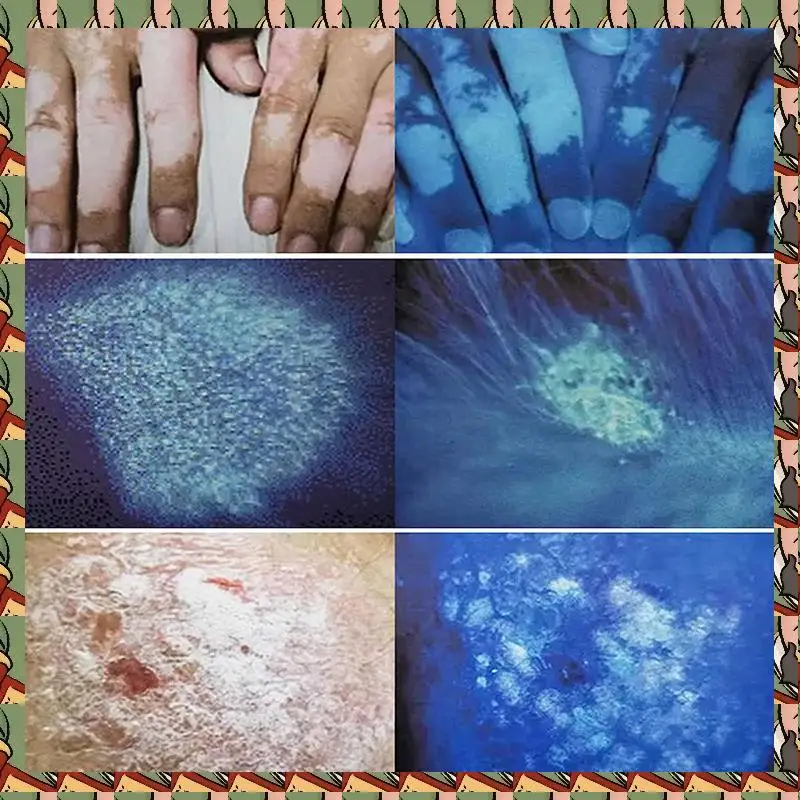 

B75A 3X Woods Lamp Skin Analyzer Portable Facial Salon Beauty Analyzer UV Woods Lamp For Skin Care Analyzing Testing