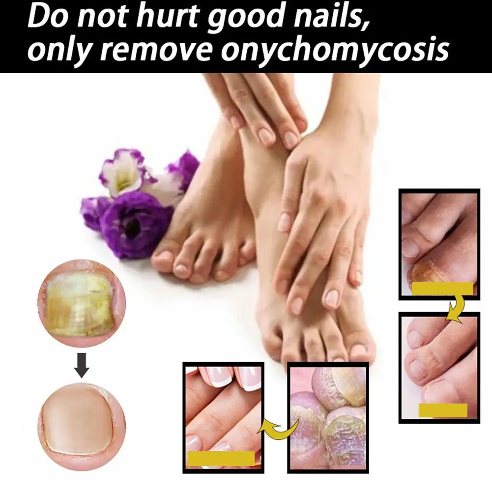 Nail Fungals Renewal Nail Repair Liquid for Discolored Thickened Crumbled Nails Nail Fungals for Discolored Broken Cracked O6G7