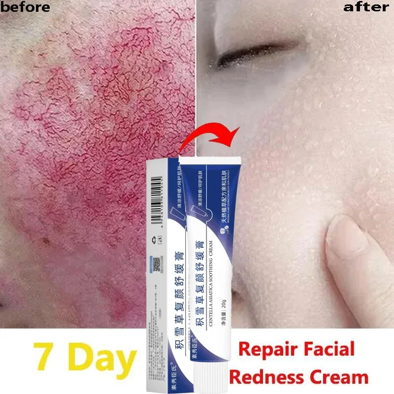 Instant Facial Redness Repair Cream Effective Soothing Red Blood Rosacea Treatment Improve Sensitive Skin Moisturizing Skin Care