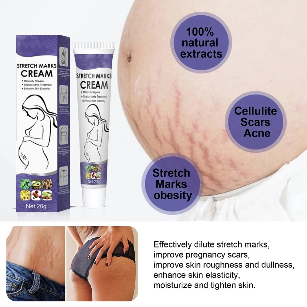 

Stretch Mark Removal Cream Permanently Removes Stretch Marks Rejuvenates Skin