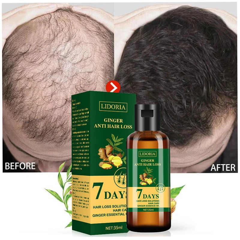 Ginger Hair Growth Essential Oil Natural Anti Hair Loss Products Fast Grow Prevent Baldness Treatment Germinal Liquid Men Women