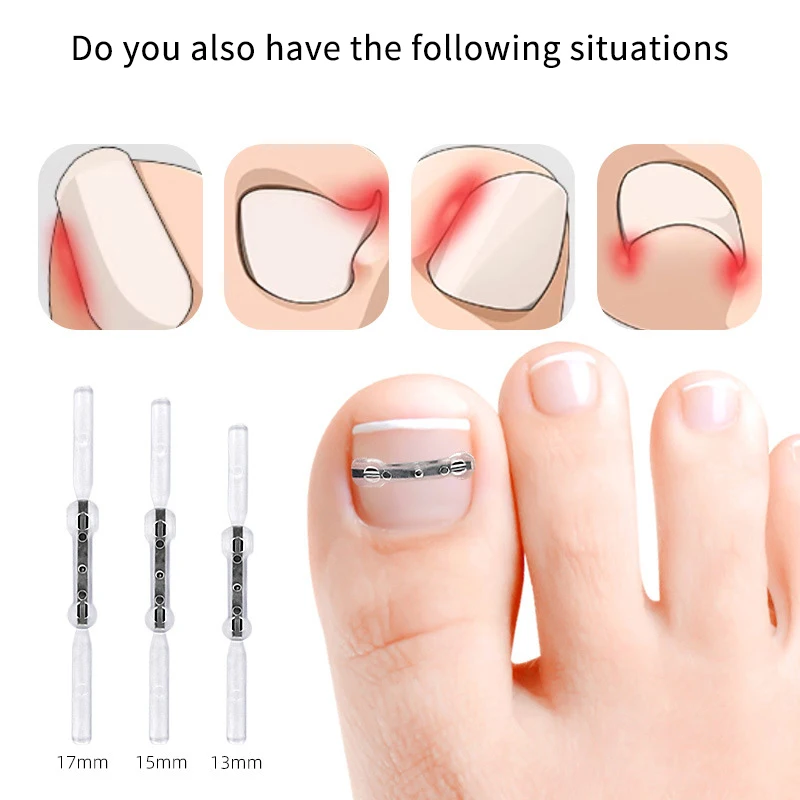 2 pçs adesivos de correção de unhas elástico encravado corretor de unhas remendos adesivo auxiliar invisível tratamento paroníquia recuperar