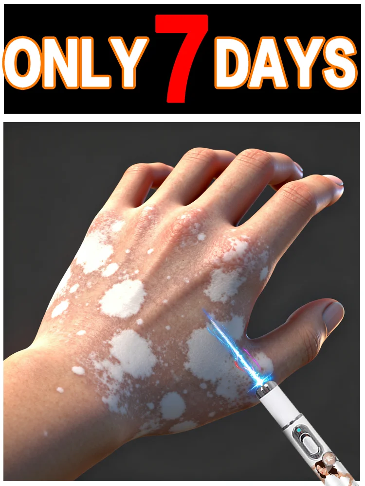 Vitiligo laser versão atualizada de segunda geração Kit de tratamento de vitiligo Rápido