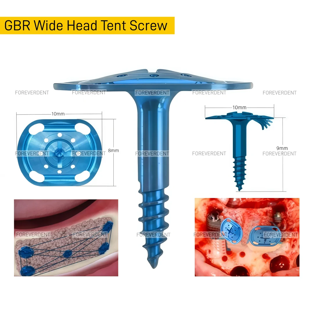 Dental GBR Tent Screws Big Tenting Screw Guided Bone Blue Driver Pole Guide Wide Head Space  Osteogenic 10MM