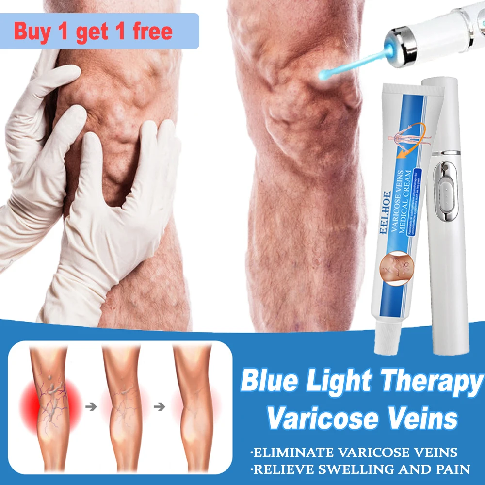 

Blue Light Therapy Varicose Veins Pen Relieves Leg Bulge Pain Effective Varicose Vein Relief Cream Treatment Vasculitis Phlebit