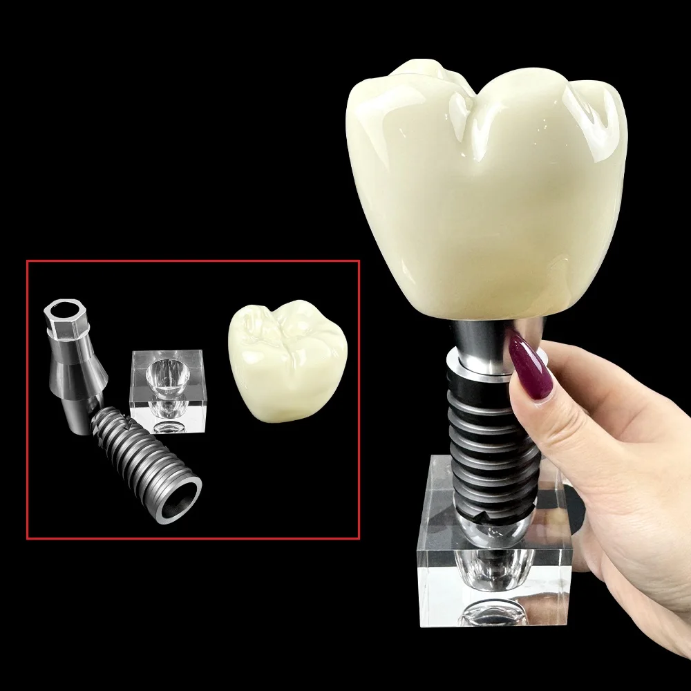 Enlarged Dental Implant Demonstration Model Detachable Crown Abutment Fixture Clear Base Teeth Structure Model Study Teaching