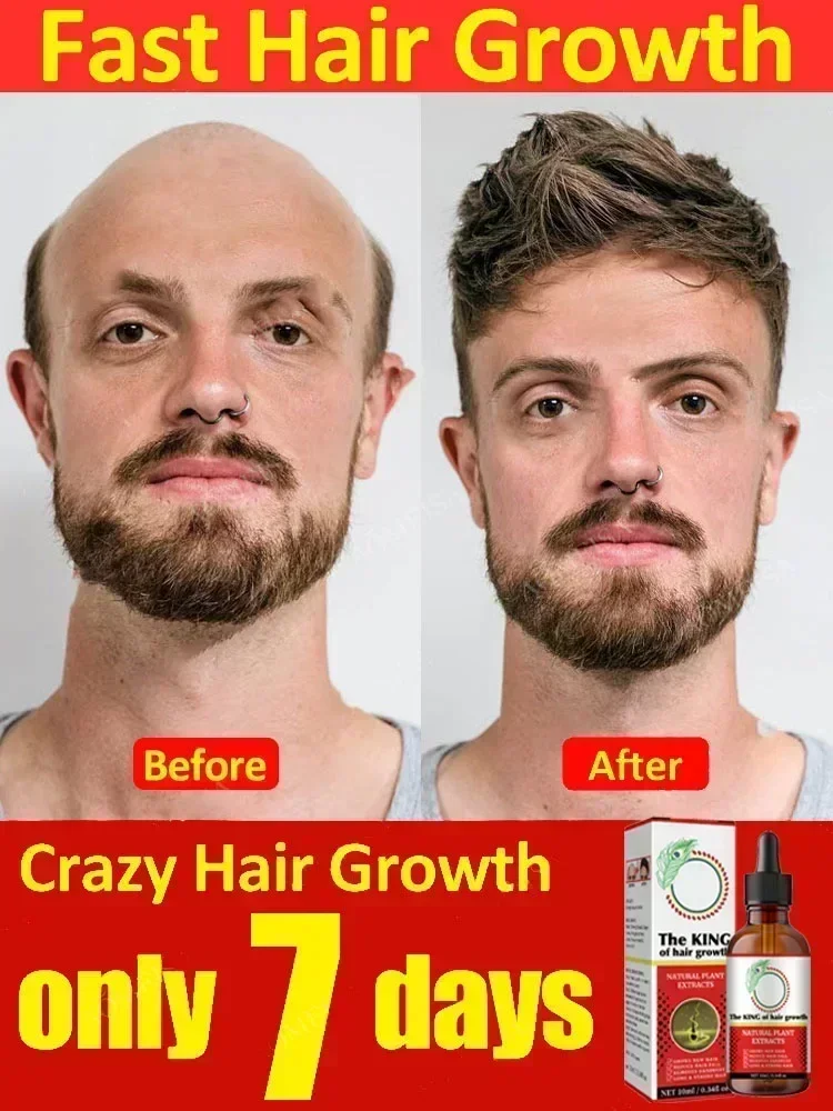 Nutre y cuida el cabello para hombres y mujeres, tratamiento de reparación de cabello con crecimiento, adelgazamiento de cabello seborreico, tratamiento de Alopecia